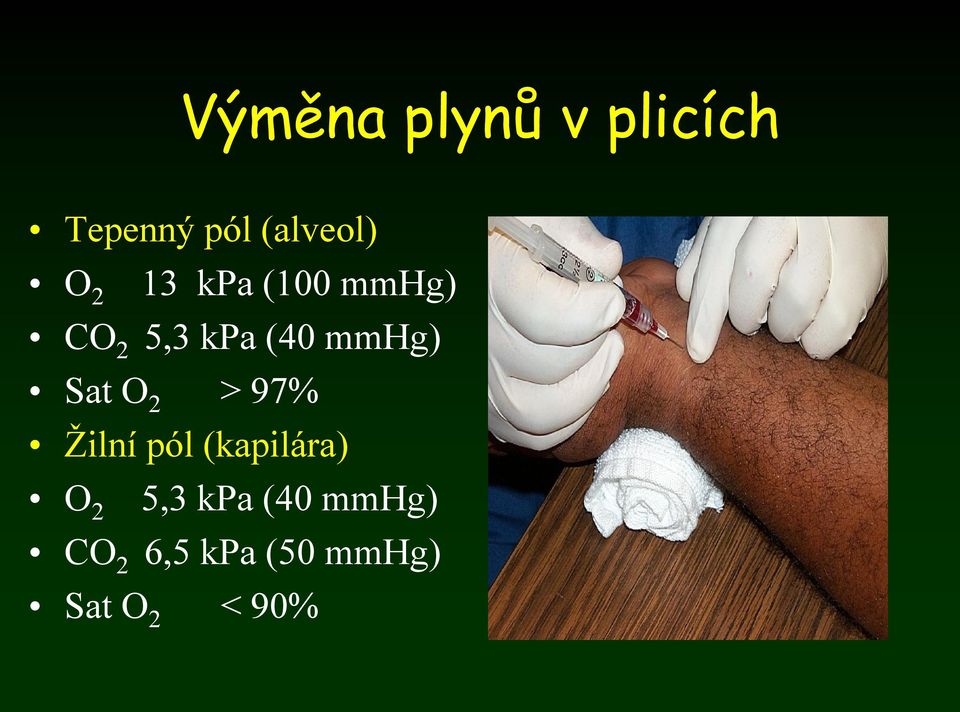 Sat O 2 > 97% Žilní pól (kapilára) O 2 5,3