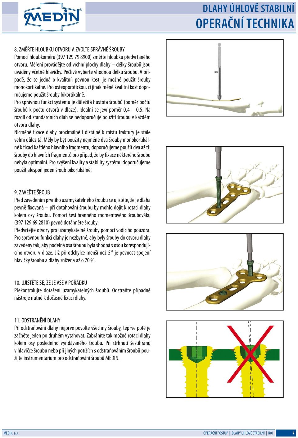 V případě, že se jedná o kvalitní, pevnou kost, je možné použít šrouby monokortikálně. Pro osteoporotickou, či jinak méně kvalitní kost doporučujeme použít šrouby bikortikálně.