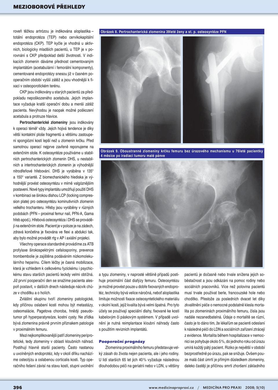 V indikacích zlomenin dáváme přednost cementovaným implantátům (acetabulární i femorální komponenty), cementované endoprotézy snesou již v časném pooperačním období vyšší zátěž a jsou vhodnější k