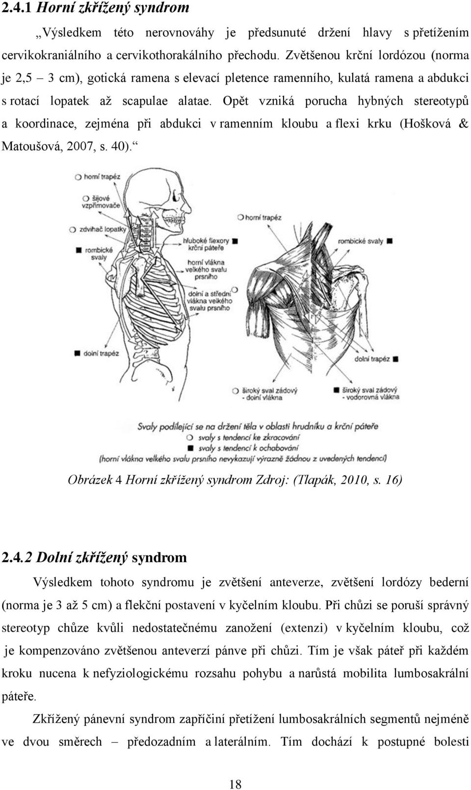 Opět vzniká porucha hybných stereotypů a koordinace, zejména při abdukci v ramenním kloubu a flexi krku (Hošková & Matoušová, 2007, s. 40). Obrázek 4 Horní zkřížený syndrom Zdroj: (Tlapák, 2010, s.