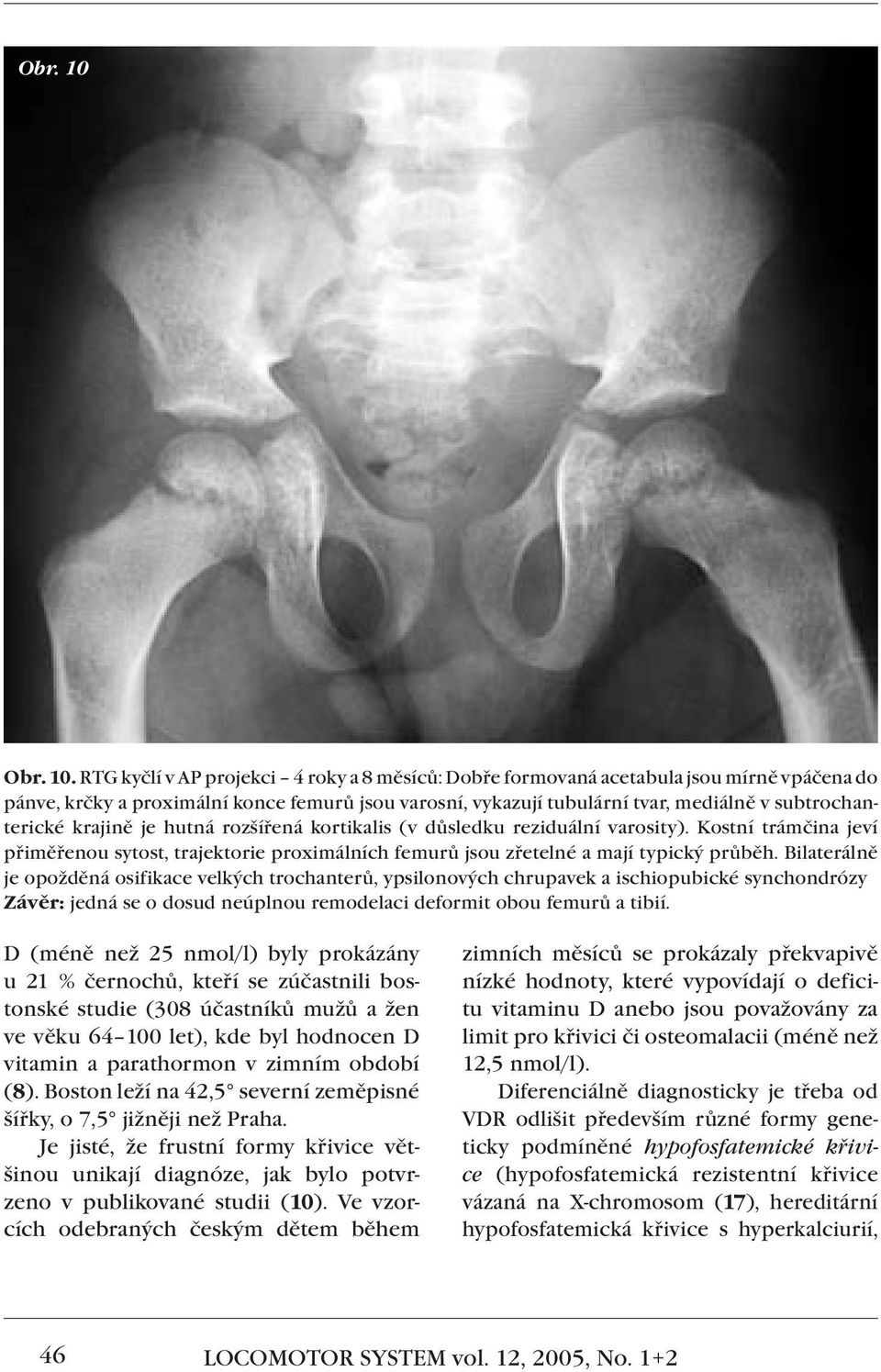 RTG kyčlí v AP projekci 4 roky a 8 měsíců: Dobře formovaná acetabula jsou mírně vpáčena do pánve, krčky a proximální konce femurů jsou varosní, vykazují tubulární tvar, mediálně v subtrochanterické