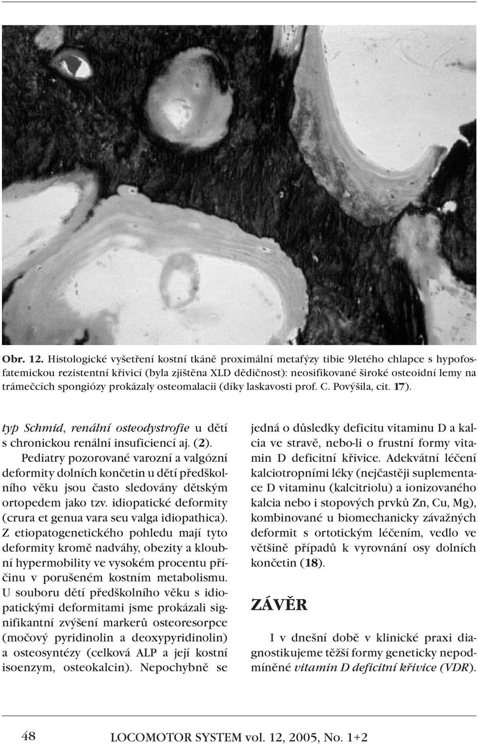 spongiózy prokázaly osteomalacii (díky laskavosti prof. C. Povýšila, cit. 17). typ Schmid, renální osteodystrofie u dětí s chronickou renální insuficiencí aj. (2).