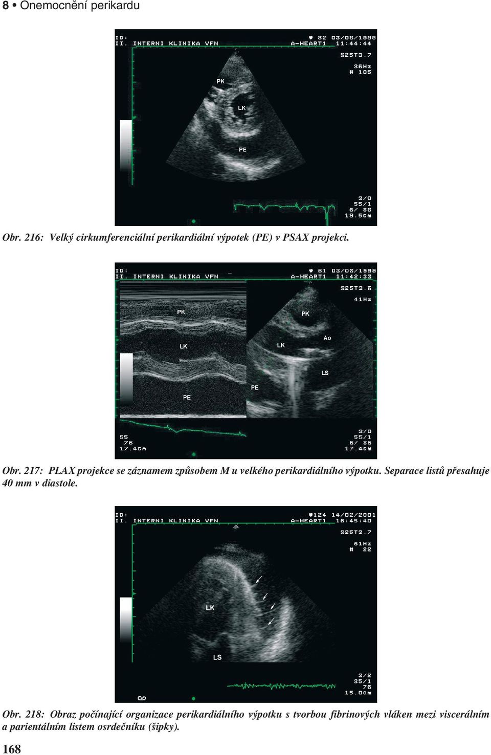 217: PLAX projekce se záznamem způsobem M u velkého perikardiálního výpotku.