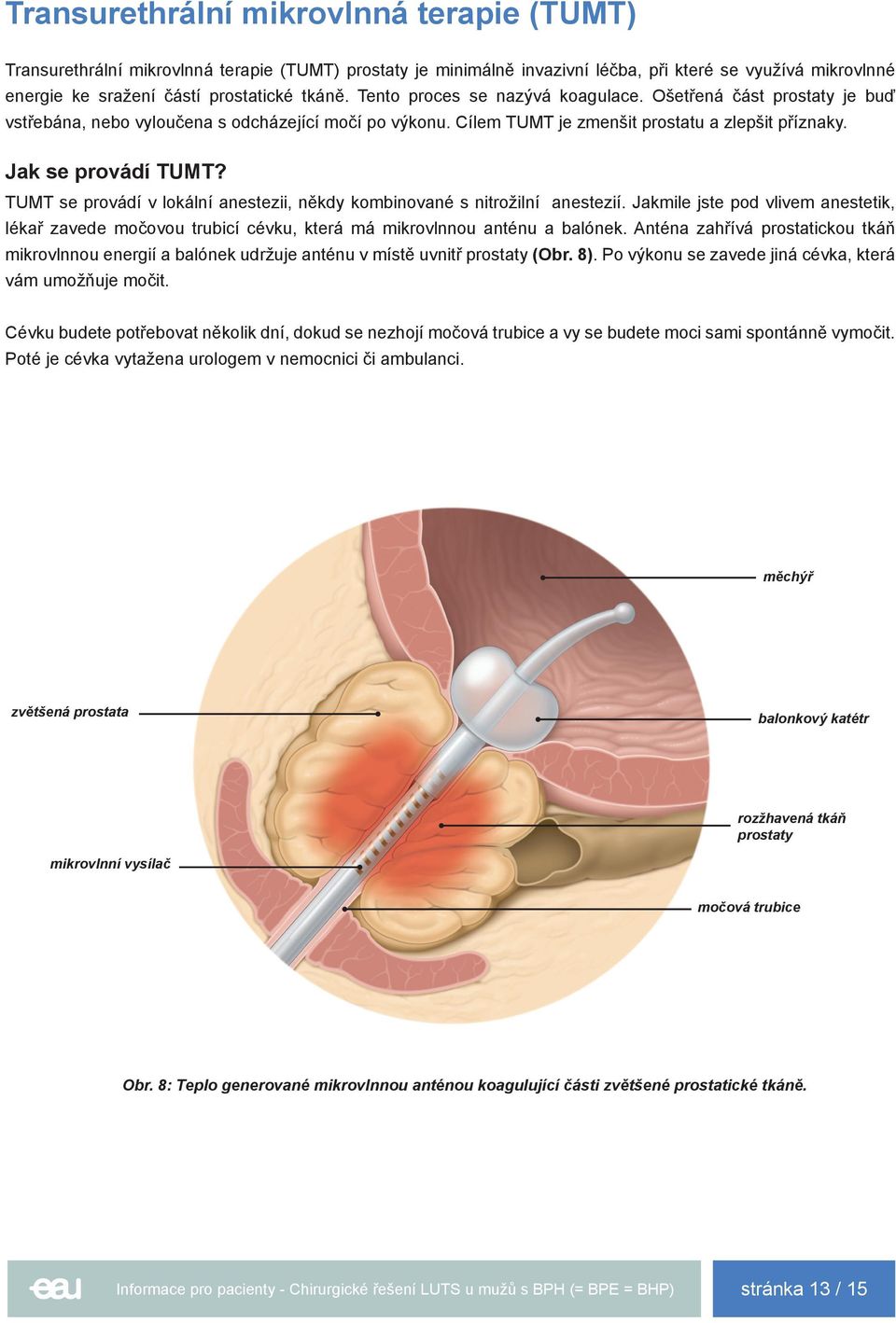 TUMT se provádí v lokální anestezii, někdy kombinované s nitrožilní anestezií. Jakmile jste pod vlivem anestetik, lékař zavede močovou trubicí cévku, která má mikrovlnnou anténu a balónek.