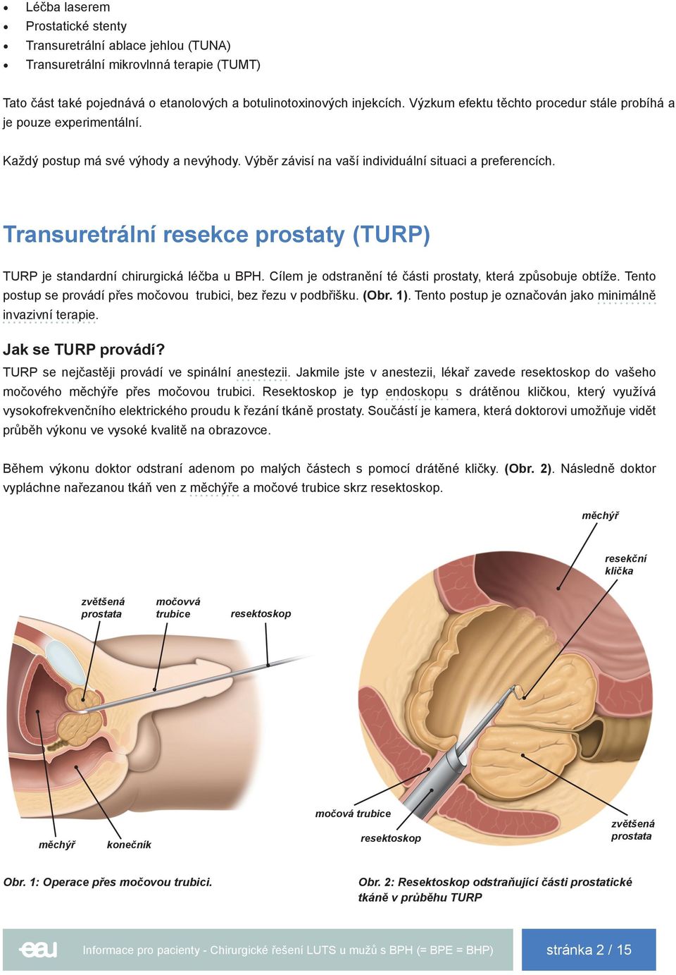 Transuretrální resekce prostaty (TURP) TURP je standardní chirurgická léčba u BPH. Cílem je odstranění té části prostaty, která způsobuje obtíže.