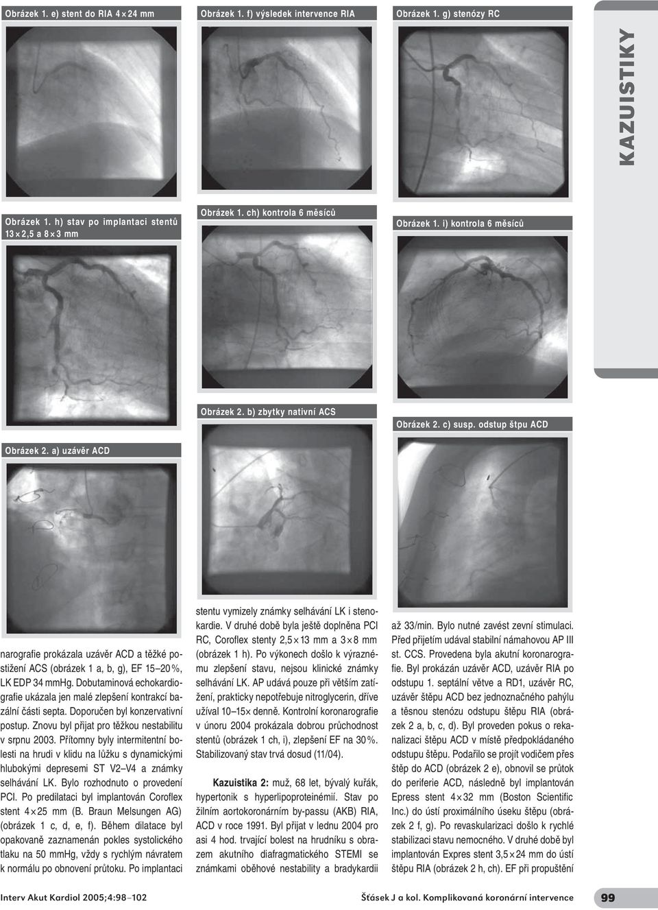 a) uzávěr ACD narografie prokázala uzávěr ACD a těžké postižení ACS (obrázek 1 a, b, g), EF 15 20 %, LK EDP 34 mmhg.