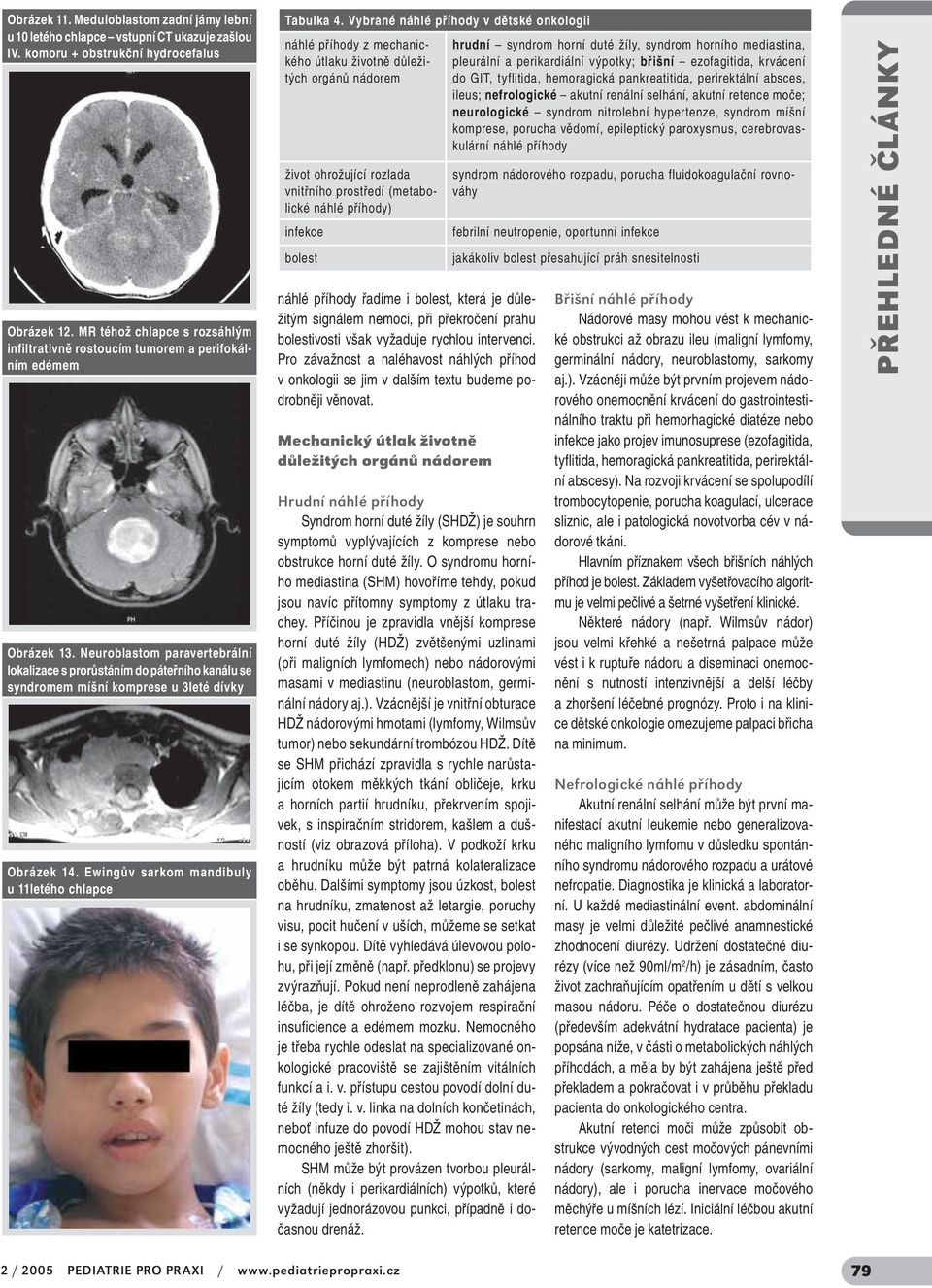 Neuroblastom paravertebrální lokalizace s prorůstáním do páteřního kanálu se syndromem míšní komprese u 3leté dívky Obrázek 14. Ewingův sarkom mandibuly u 11letého chlapce Tabulka 4.