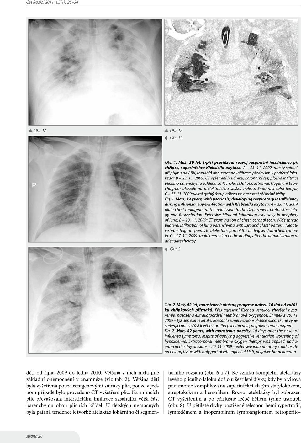 2009: CT vyšetření hrudníku, koronární řez, plošná infiltrace plicního parenchymu vzhledu mléčného skla oboustranně. Negativní bronchogram ukazuje na atelektatickou složku nálezu.