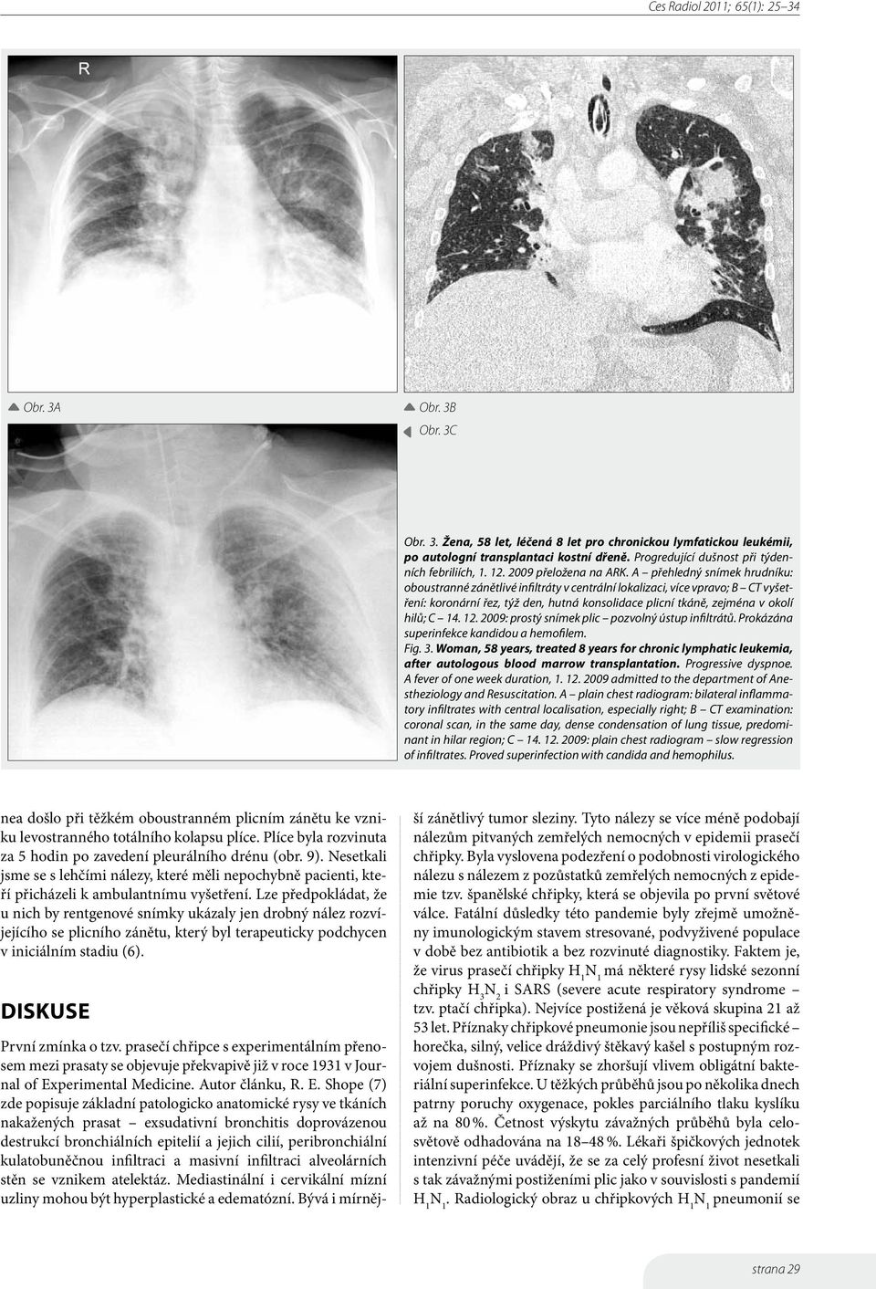 A přehledný snímek hrudníku: oboustranné zánětlivé infiltráty v centrální lokalizaci, více vpravo; B CT vyšetření: koronární řez, týž den, hutná konsolidace plicní tkáně, zejména v okolí hilů; C 14.