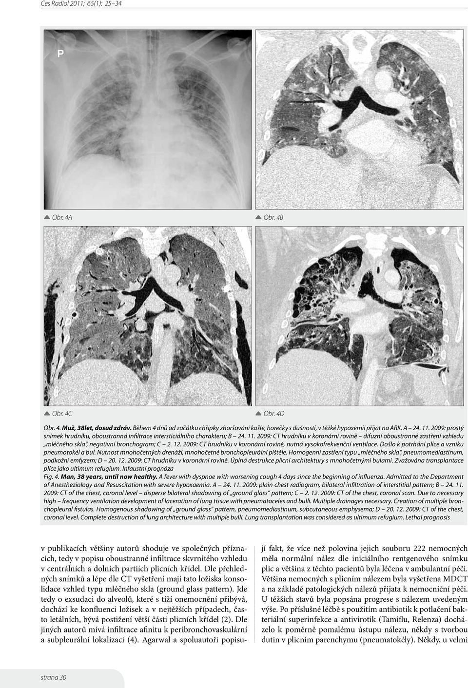 2009: CT hrudníku v koronární rovině difuzní oboustranné zastření vzhledu mléčného skla, negativní bronchogram; C 2. 12. 2009: CT hrudníku v koronární rovině, nutná vysokofrekvenční ventilace.
