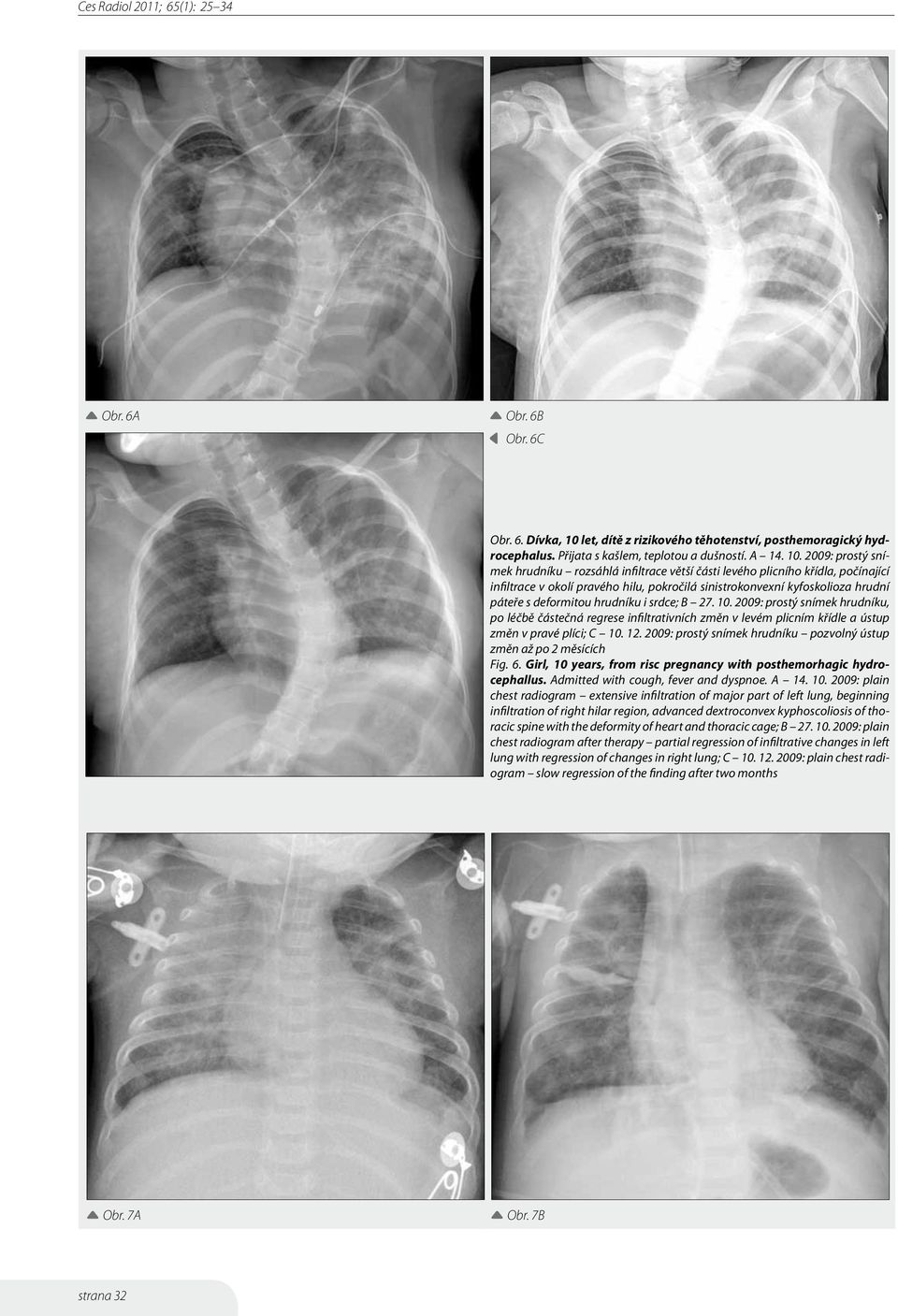 2009: prostý snímek hrudníku rozsáhlá infiltrace větší části levého plicního křídla, počínající infiltrace v okolí pravého hilu, pokročilá sinistrokonvexní kyfoskolioza hrudní páteře s deformitou