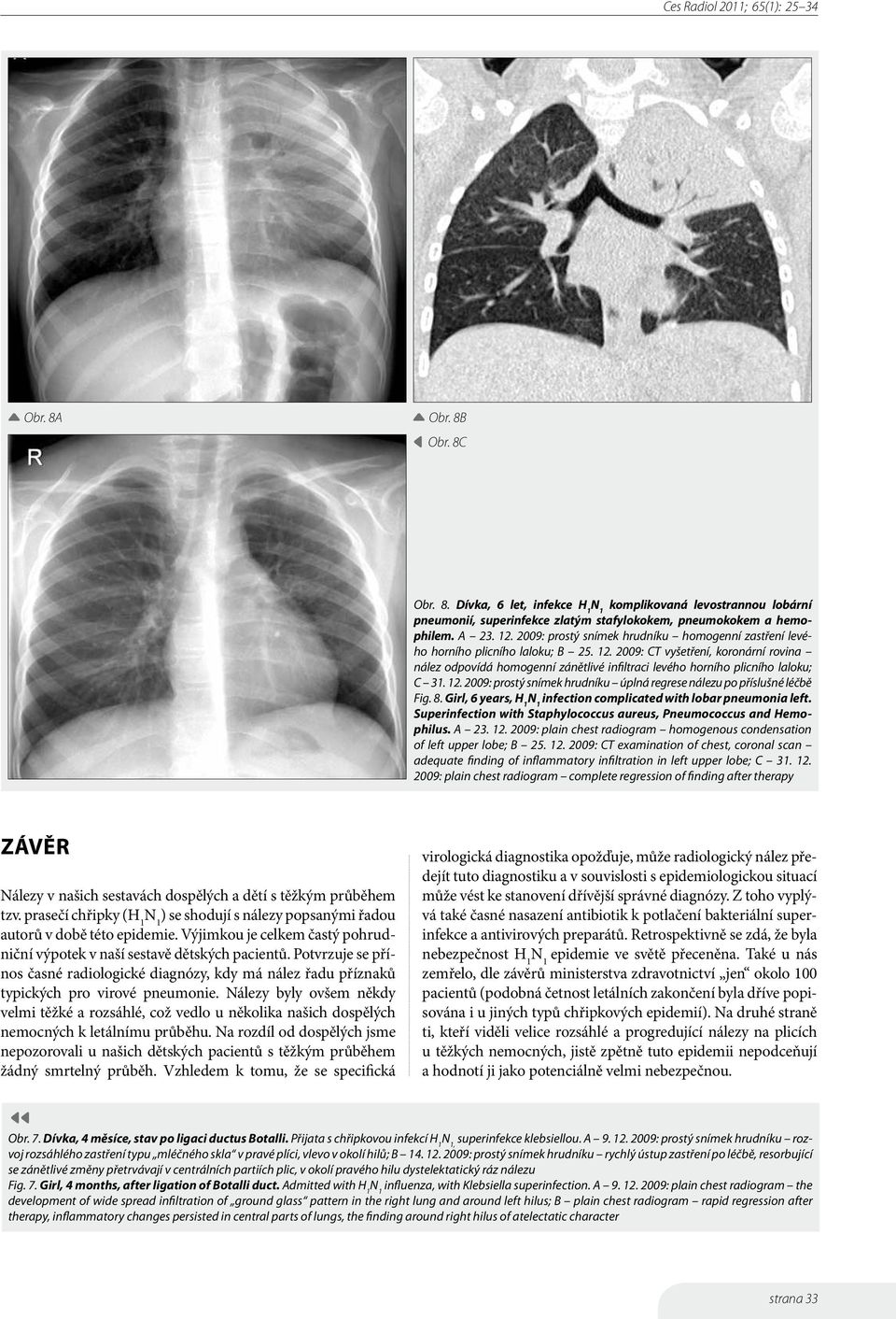 2009: CT vyšetření, koronární rovina nález odpovídá homogenní zánětlivé infiltraci levého horního plicního laloku; C 31. 12. 2009: prostý snímek hrudníku úplná regrese nálezu po příslušné léčbě Fig.