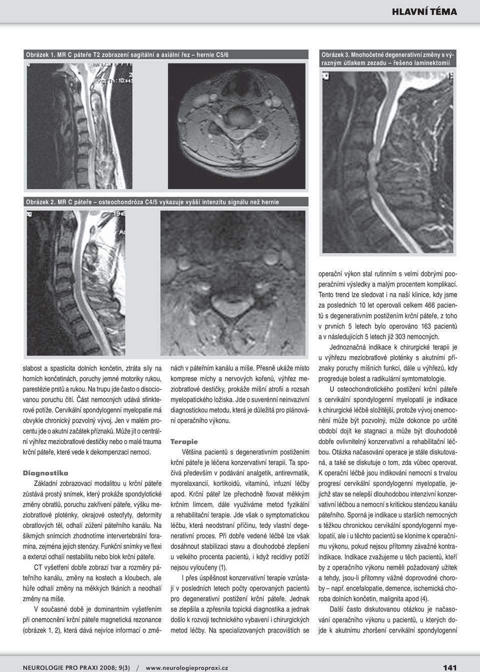 rukou. Na trupu jde často o disociovanou poruchu čití. Část nemocných udává sfinkterové potíže. Cervikální spondylogenní myelopatie má obvykle chronický pozvolný vývoj.