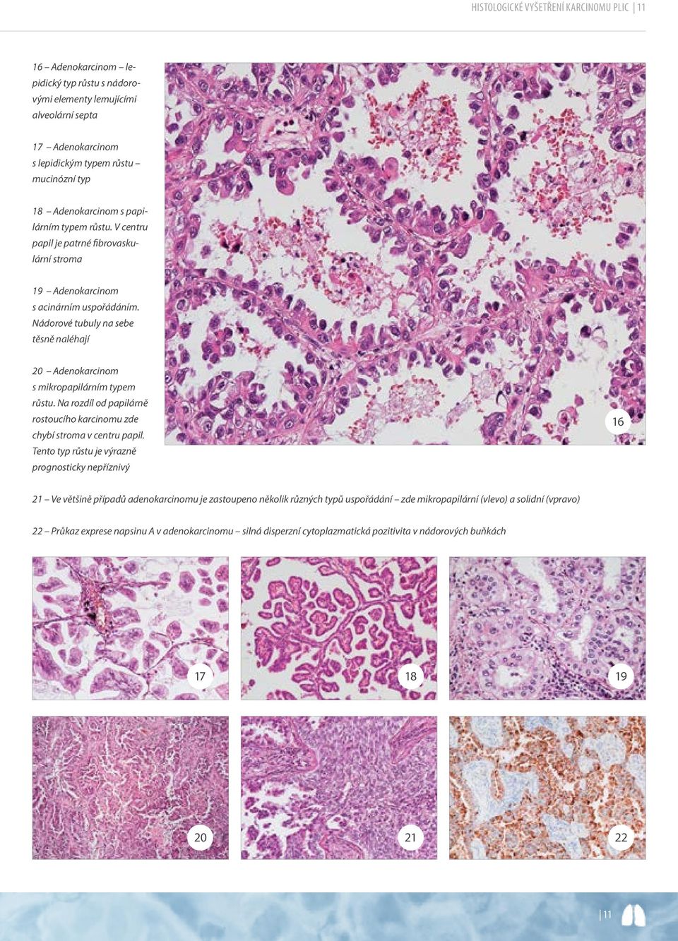 Nádorové tubuly na sebe těsně naléhají 20 Adenokarcinom s mikropapilárním typem růstu. Na rozdíl od papilárně rostoucího karcinomu zde chybí stroma v centru papil.