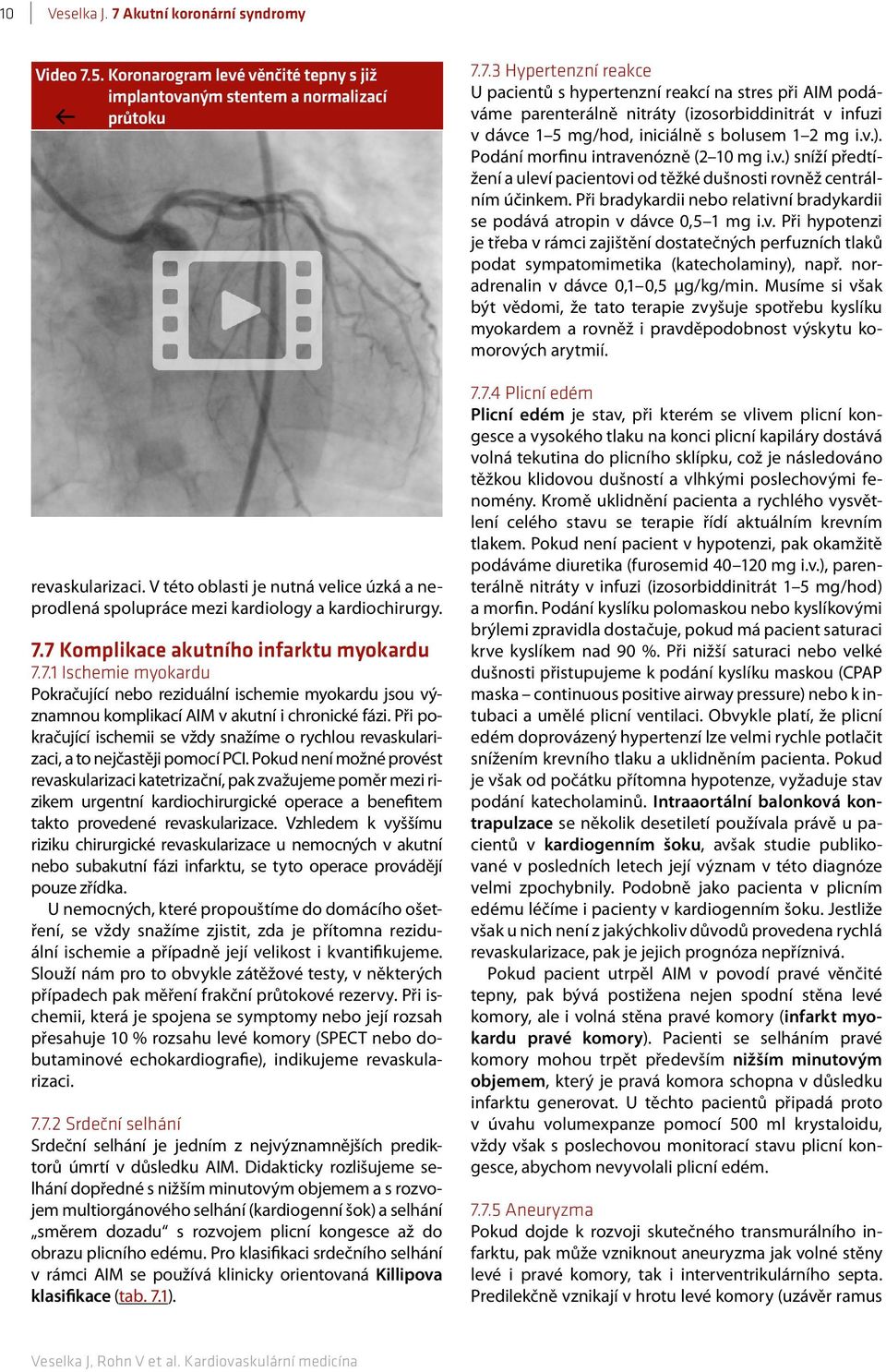 7 Komplikace akutního infarktu myokardu 7.7.1 Ischemie myokardu Pokračující nebo reziduální ischemie myokardu jsou významnou komplikací AIM v akutní i chronické fázi.