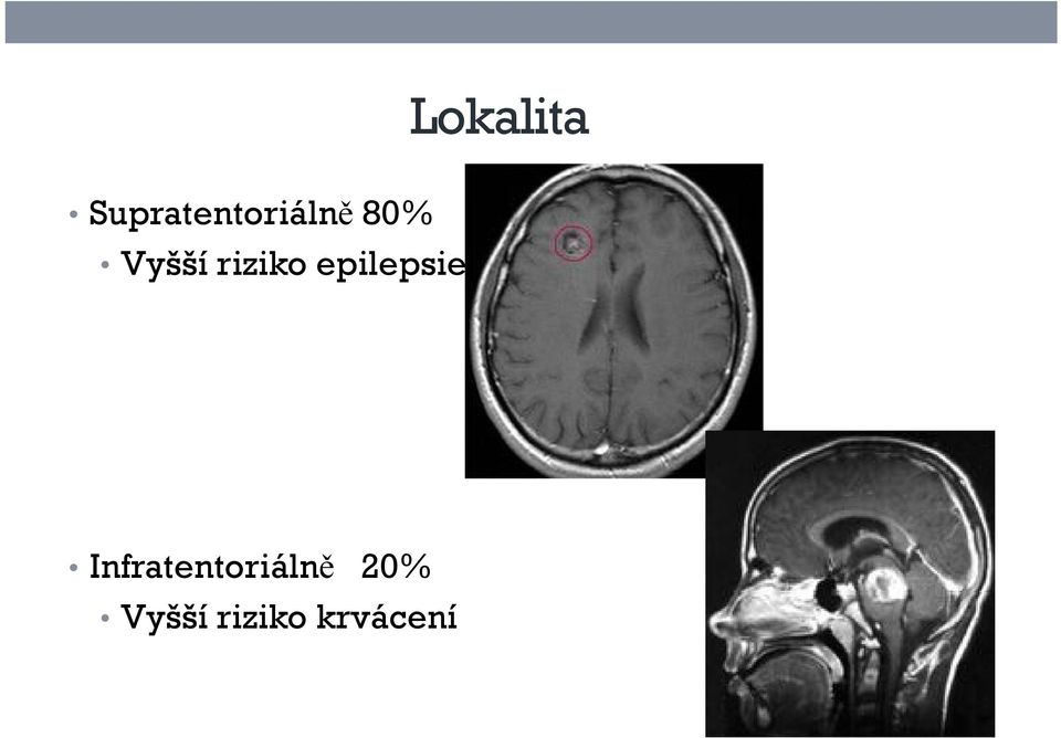 Vyšší riziko epilepsie