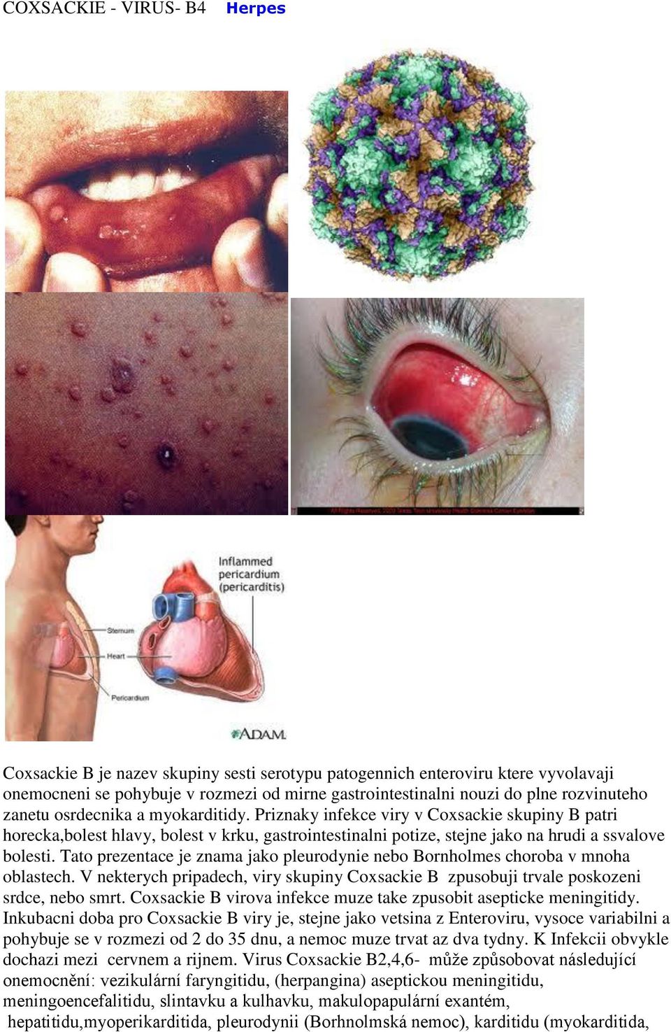 Tato prezentace je znama jako pleurodynie nebo Bornholmes choroba v mnoha oblastech. V nekterych pripadech, viry skupiny Coxsackie B zpusobuji trvale poskozeni srdce, nebo smrt.