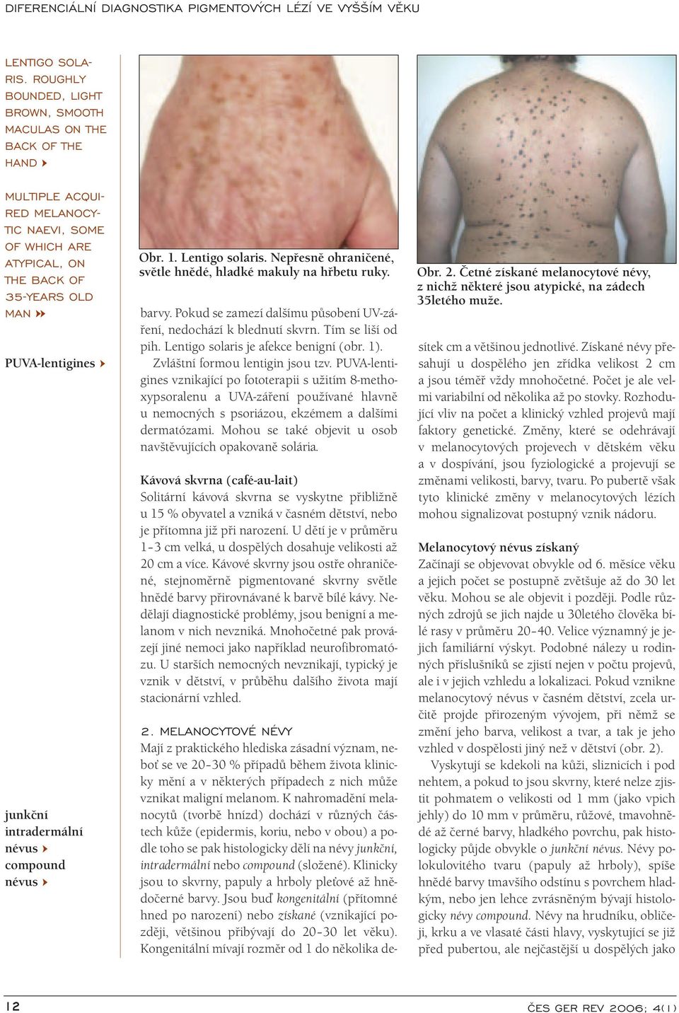 intradermální compound Obr. 1. Lentigo solaris. Nepřesně ohraničené, světle hnědé, hladké makuly na hřbetu ruky. barvy. Pokud se zamezí dalšímu působení UV-záření, nedochází k blednutí skvrn.