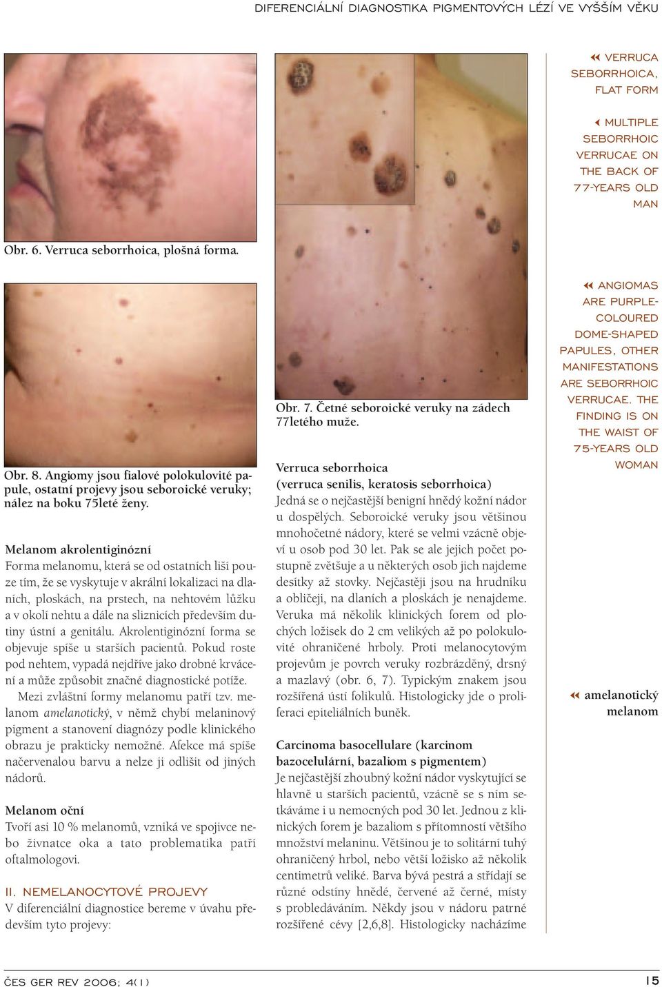 Melanom akrolentiginózní Forma melanomu, která se od ostatních liší pouze tím, že se vyskytuje v akrální lokalizaci na dlaních, ploskách, na prstech, na nehtovém lůžku a v okolí nehtu a dále na