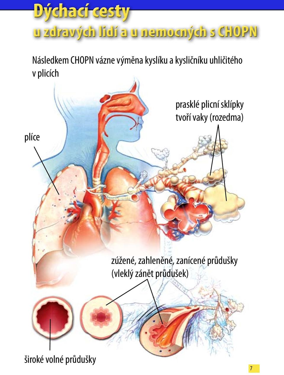 plíce prasklé plicní sklípky tvoří vaky (rozedma) zúžené,