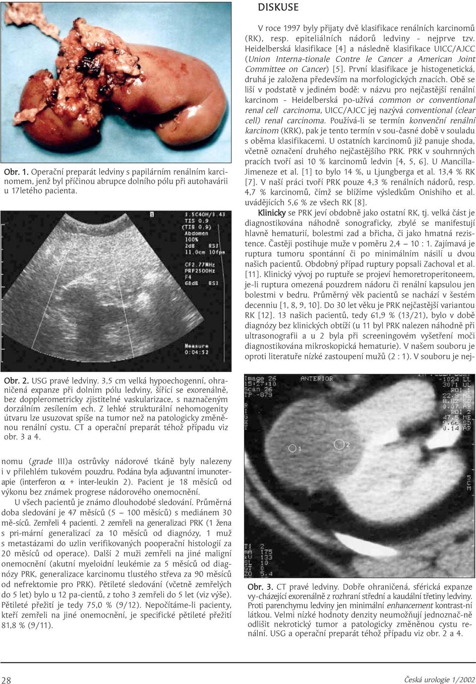 Heidelberská klasifikace [4] a následně klasifikace UICC/AJCC (Union Interna-tionale Contre le Cancer a American Joint Committee on Cancer) [5].