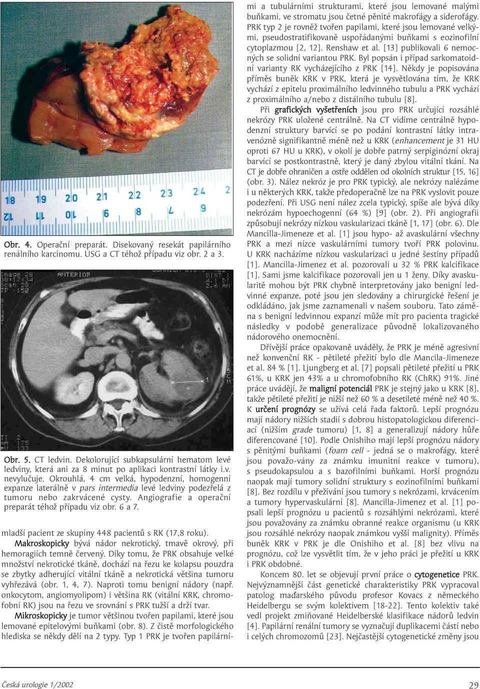 Okrouhlá, 4 cm velká, hypodenzní, homogenní expanze laterálně v pars intermedia levé ledviny podezřelá z tumoru nebo zakrvácené cysty. Angiografie a operační preparát téhož případu viz obr. 6 a 7.