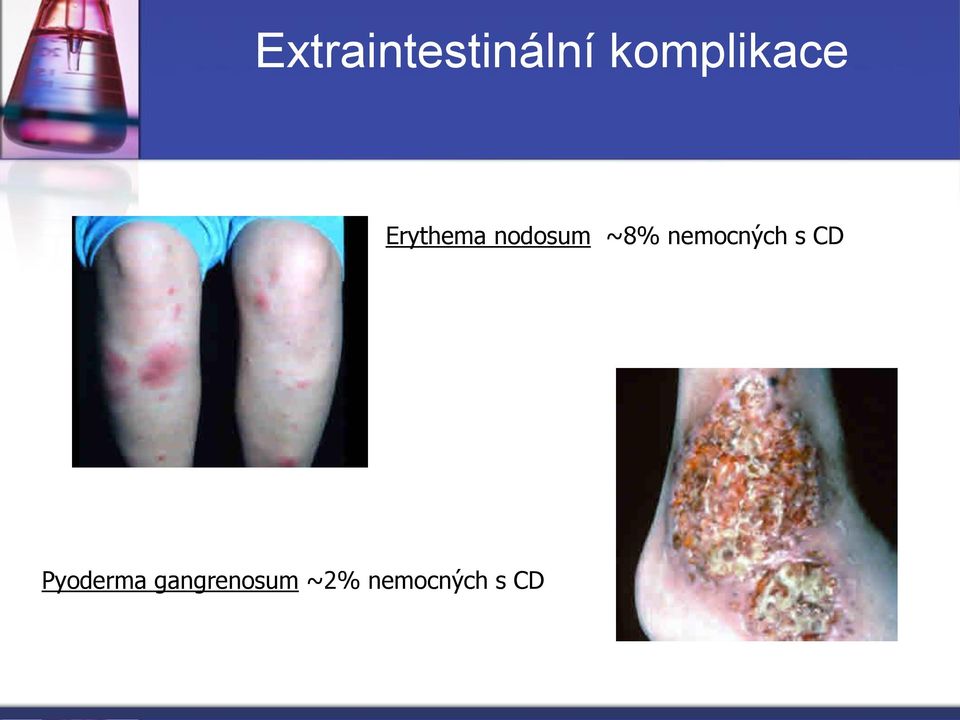 nodosum ~8% nemocných s