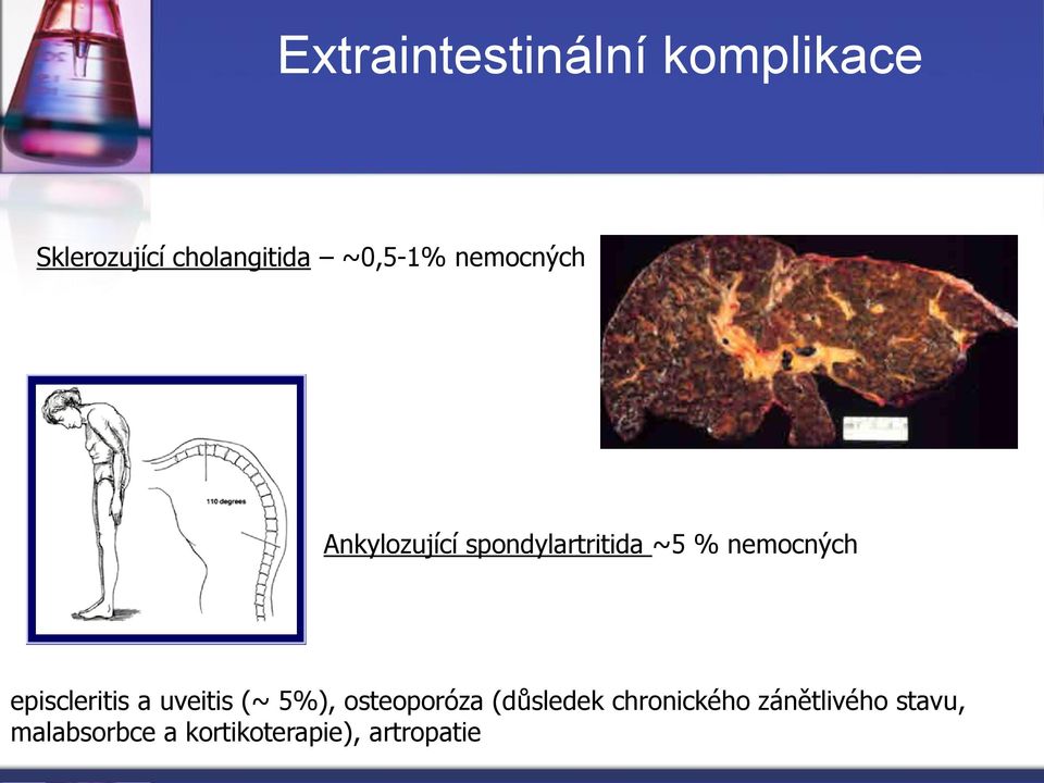 nemocných episcleritis a uveitis (~ 5%), osteoporóza