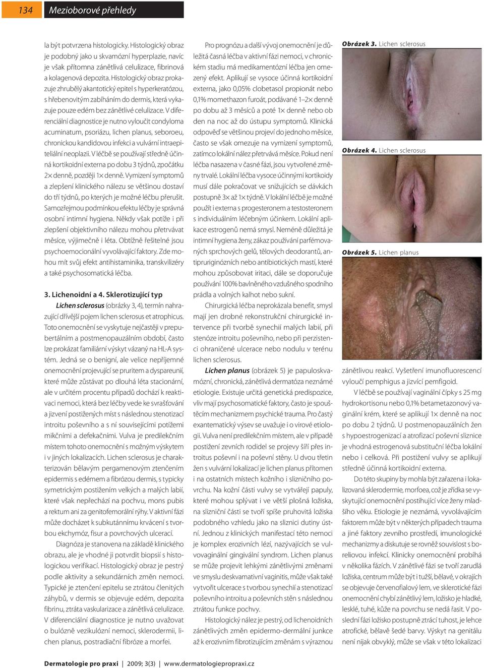 V diferenciální diagnostice je nutno vyloučit condyloma acuminatum, psoriázu, lichen planus, seboroeu, chronickou kandidovou infekci a vulvární intraepiteliální neoplazii.