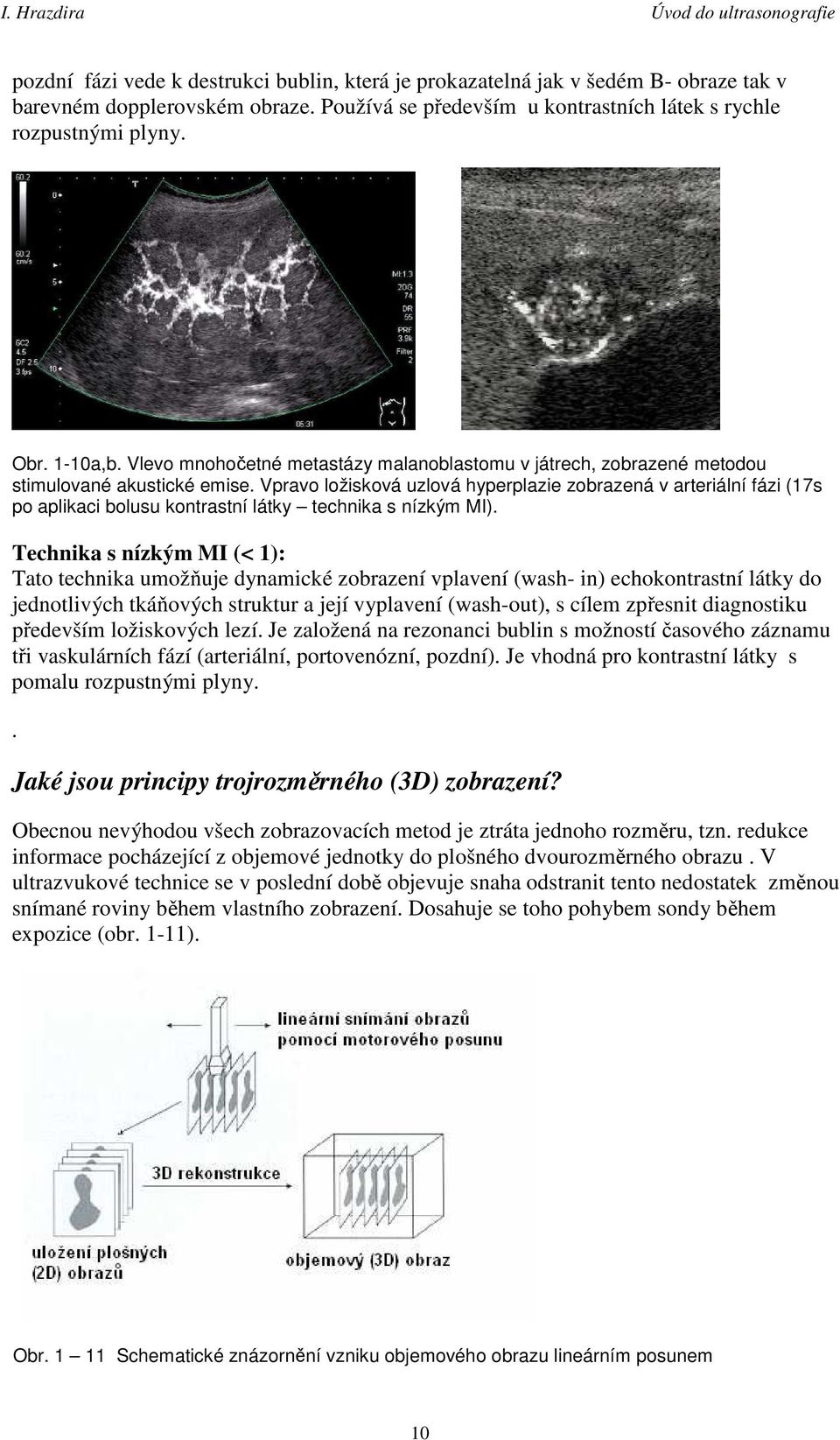 Vpravo ložisková uzlová hyperplazie zobrazená v arteriální fázi (17s po aplikaci bolusu kontrastní látky technika s nízkým MI).