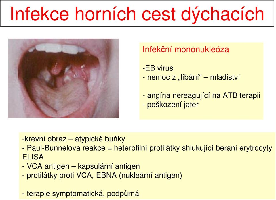 Paul-Bunnelova reakce = heterofilní protilátky shlukující beraní erytrocyty ELISA - VCA