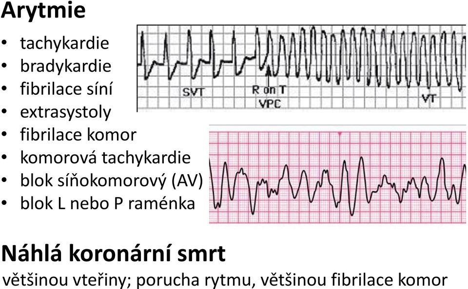 síňokomorový (AV) blok L nebo P raménka Náhlá