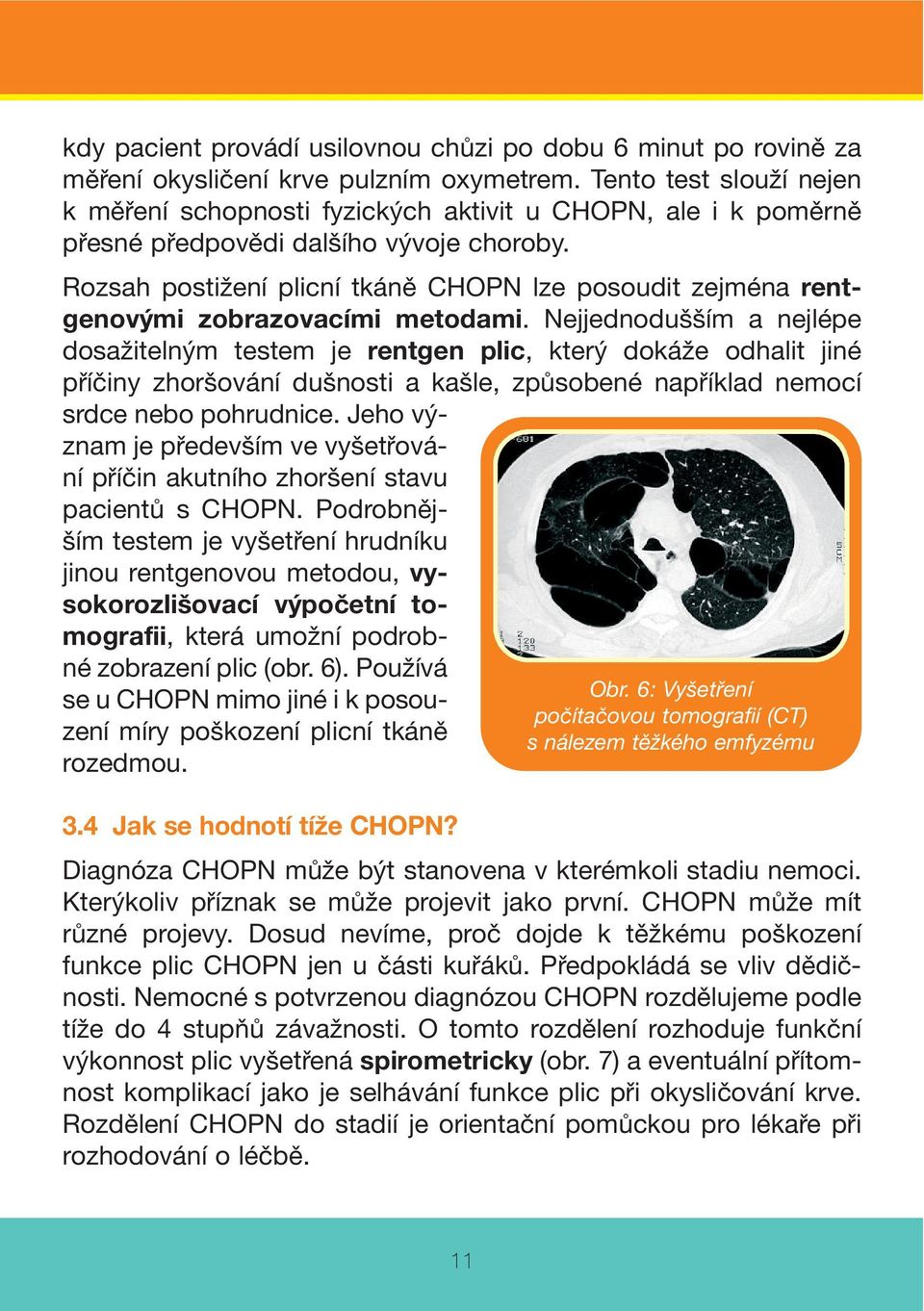 Rozsah postižení plicní tkáně CHOPN lze posoudit zejména rentgenovými zobrazovacími metodami.