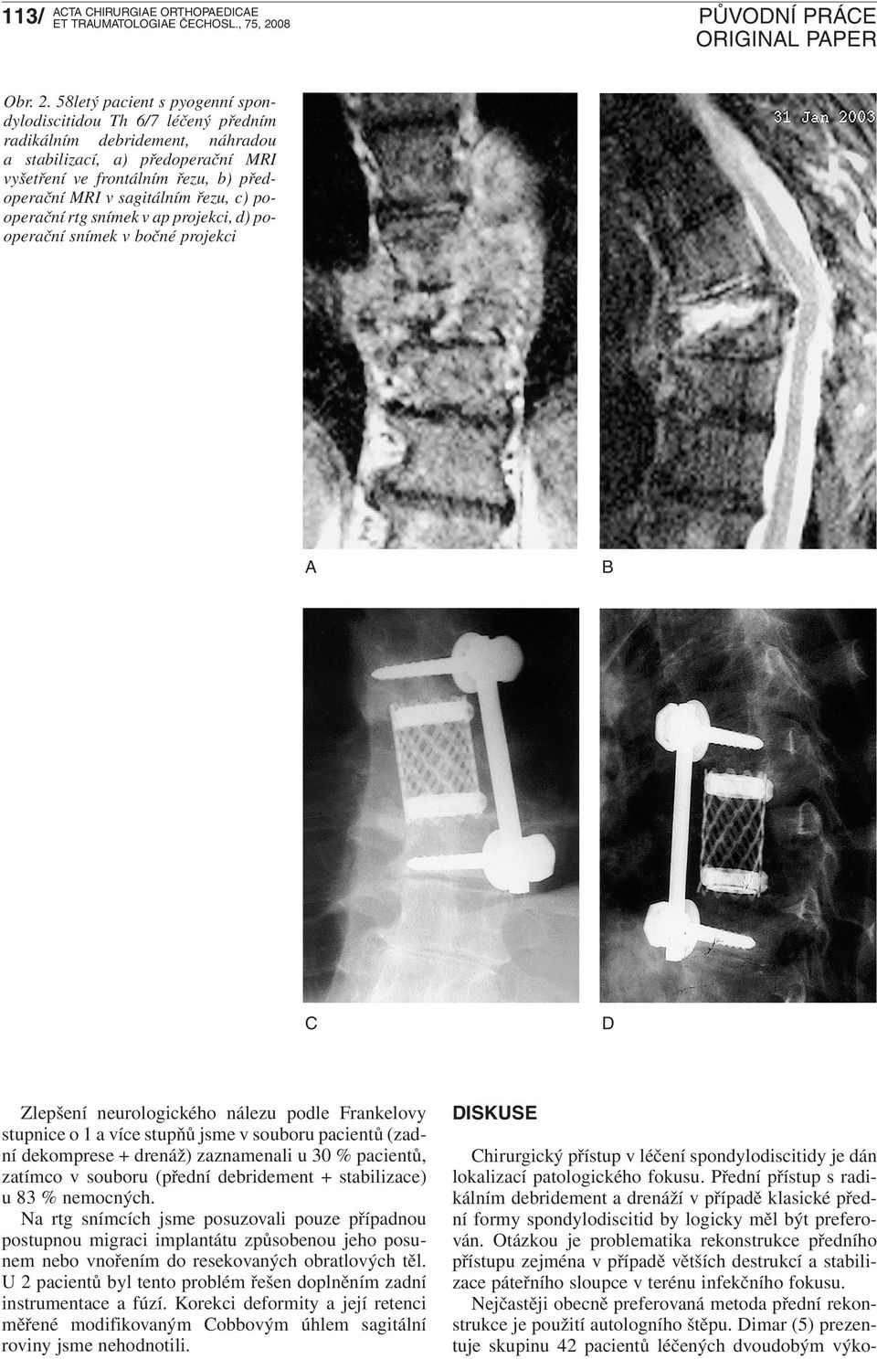 řezu, c) pooperační rtg snímek v ap projekci, d) pooperační snímek v bočné projekci A B C D Zlepšení neurologického nálezu podle Frankelovy stupnice o 1 a více stupňů jsme v souboru pacientů (zadní