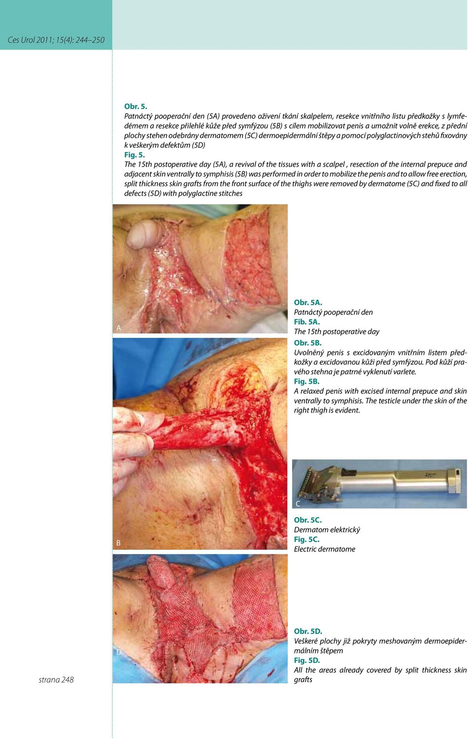 erekce, z přední plochy stehen odebrány dermatomem (5C) dermoepidermální štěpy a pomocí polyglactinových stehů fixovány k veškerým defektům (5D) Fig. 5.