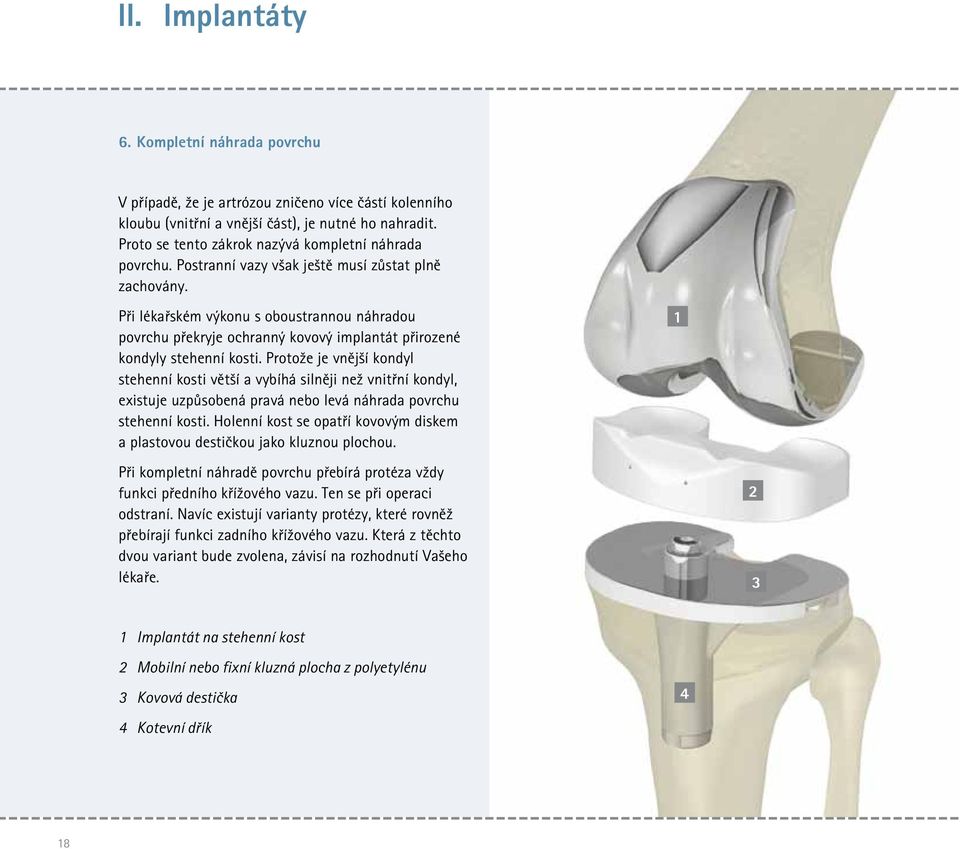 Při lékařském výkonu s oboustrannou náhradou povrchu překryje ochranný kovový implantát přirozené kondyly stehenní kosti.