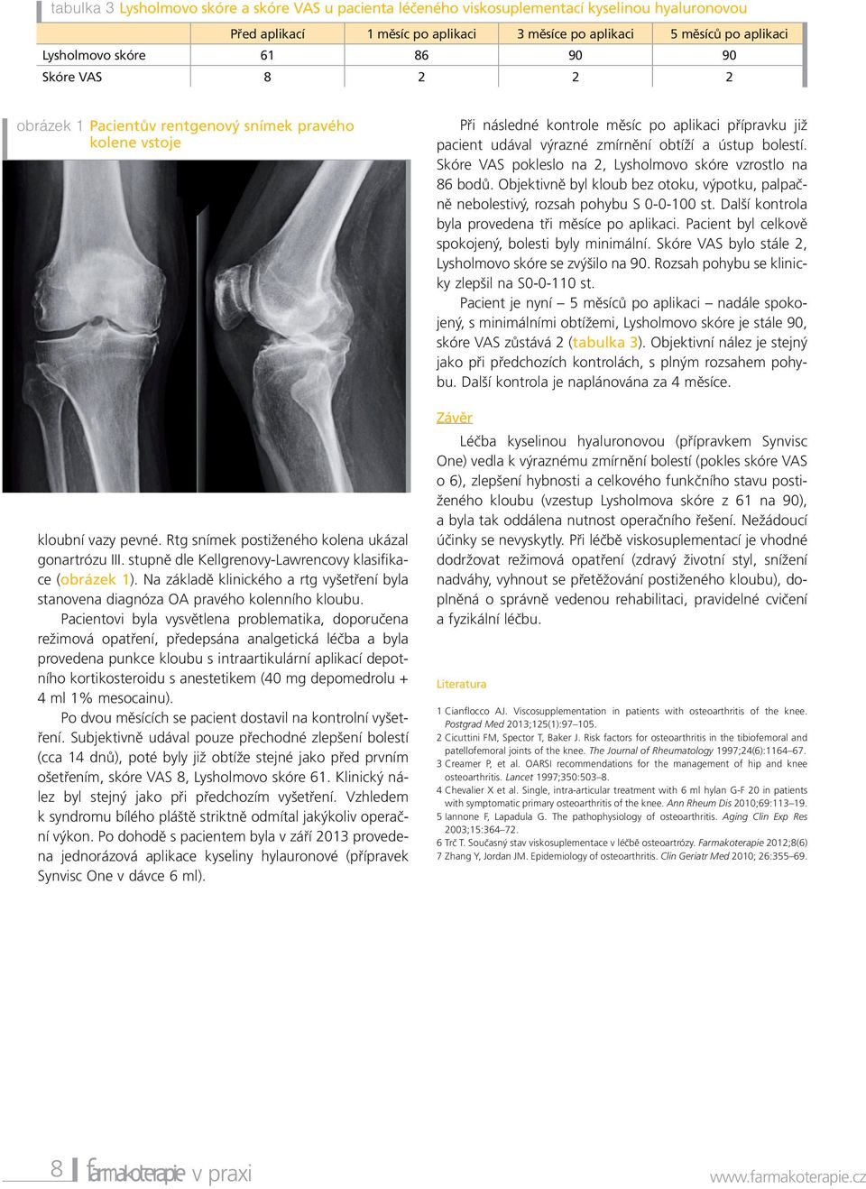 stupně dle Kellgrenovy-Lawrencovy klasifikace (obrázek 1). Na základě klinického a rtg vyšetření byla stanovena diagnóza OA pravého kolenního kloubu.