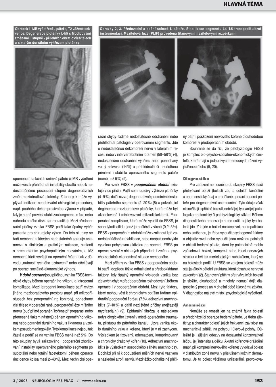 Mezitělová fuze (PLIF) provedena titanovými mezitělovými rozpěrkami opomenutí funkčních snímků páteře či MR vyšetření může vést k přehlédnutí instability obratlů nebo k nedostatečnému posouzení