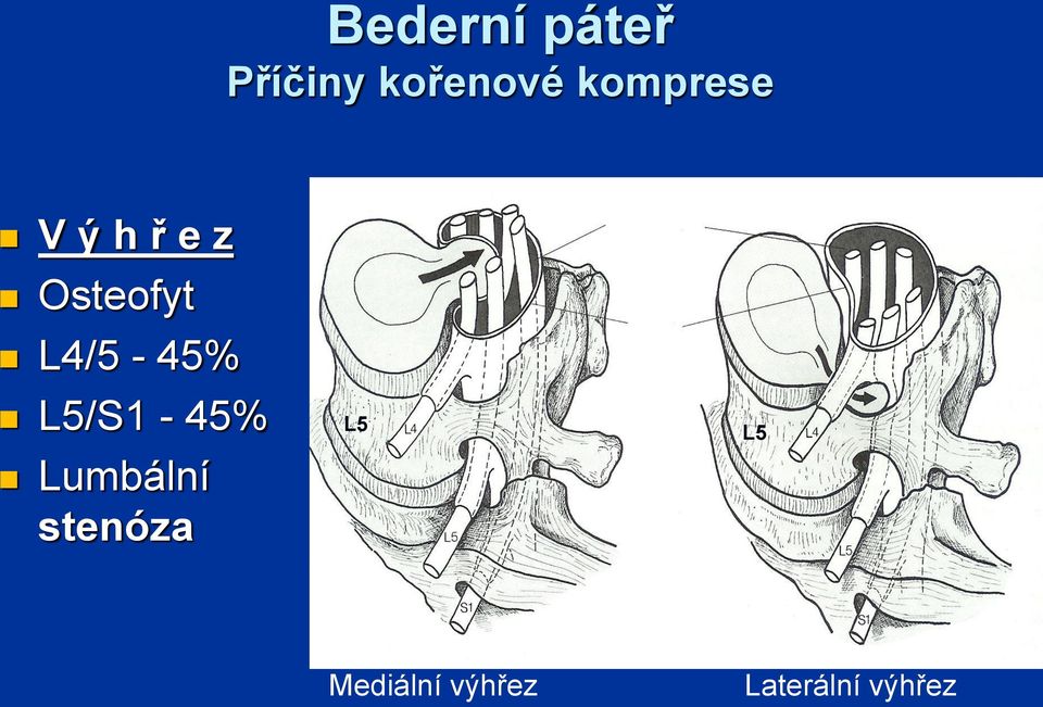 L4/5-45% L5/S1-45% Lumbální