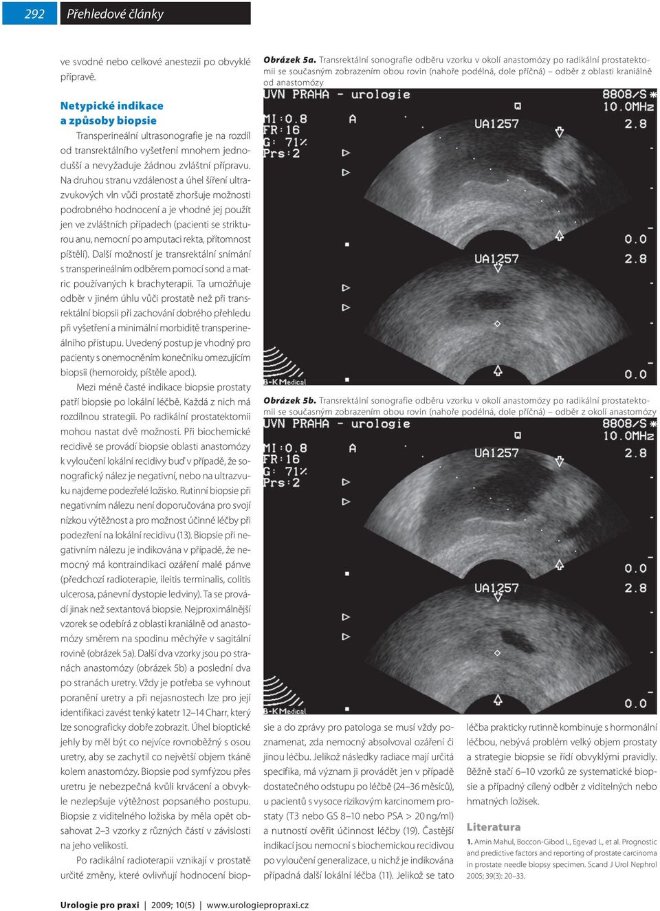 5b. Transrektální sonografie odběru vzorku v okolí anastomózy po radikální prostatektomii se současným zobrazením obou rovin (nahoře podélná, dole příčná) odběr z okolí anastomózy Netypické indikace