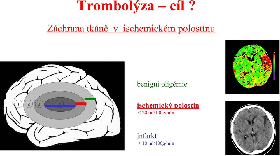 polostínu benigní oligémie