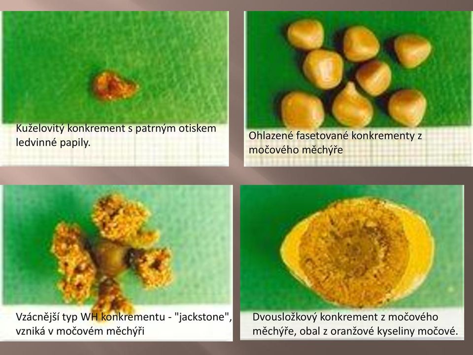 typ WH konkrementu - "jackstone", vzniká v močovém měchýři