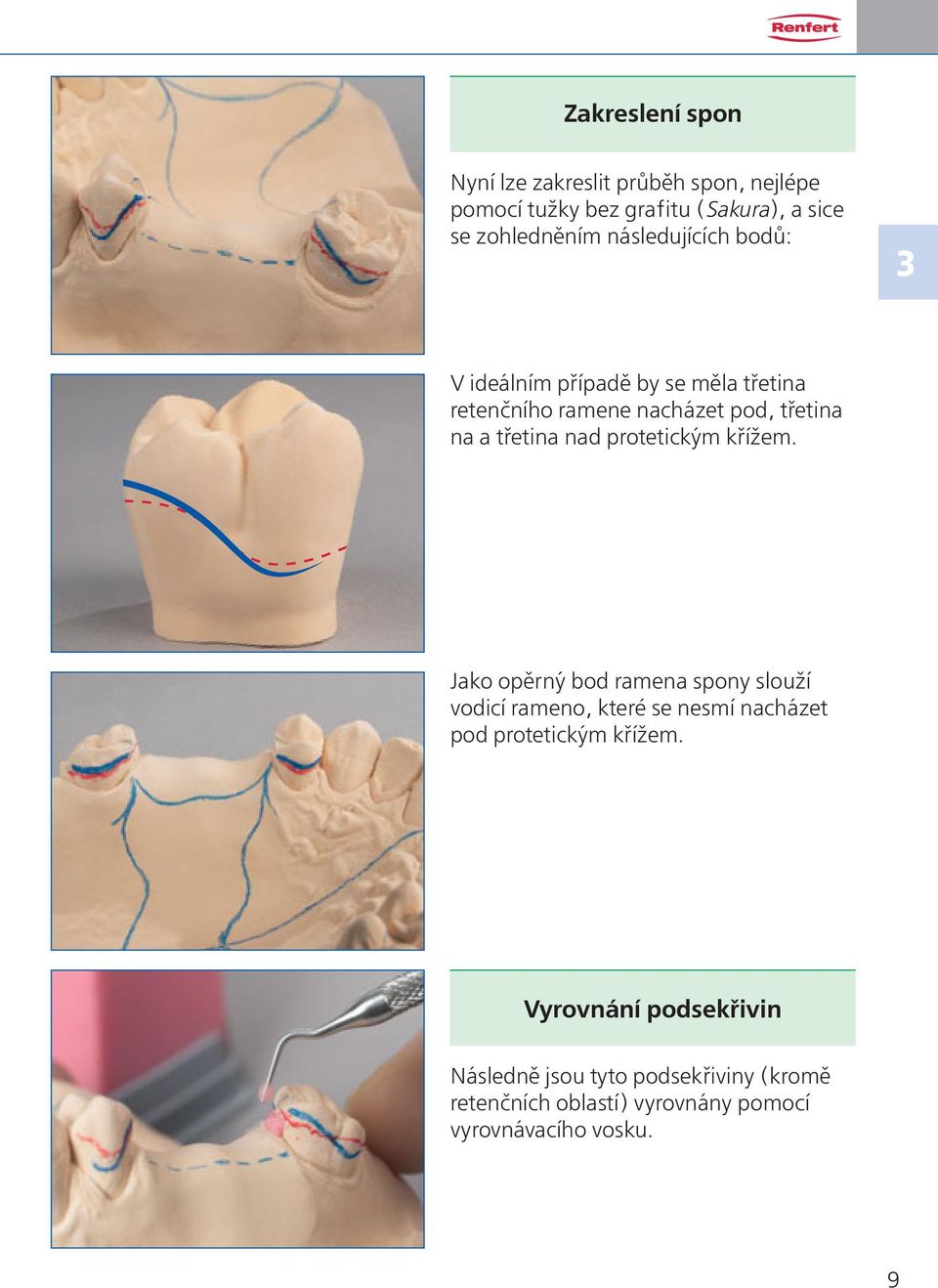 protetickým křížem. Jako opěrný bod ramena spony slouží vodicí rameno, které se nesmí nacházet pod protetickým křížem.