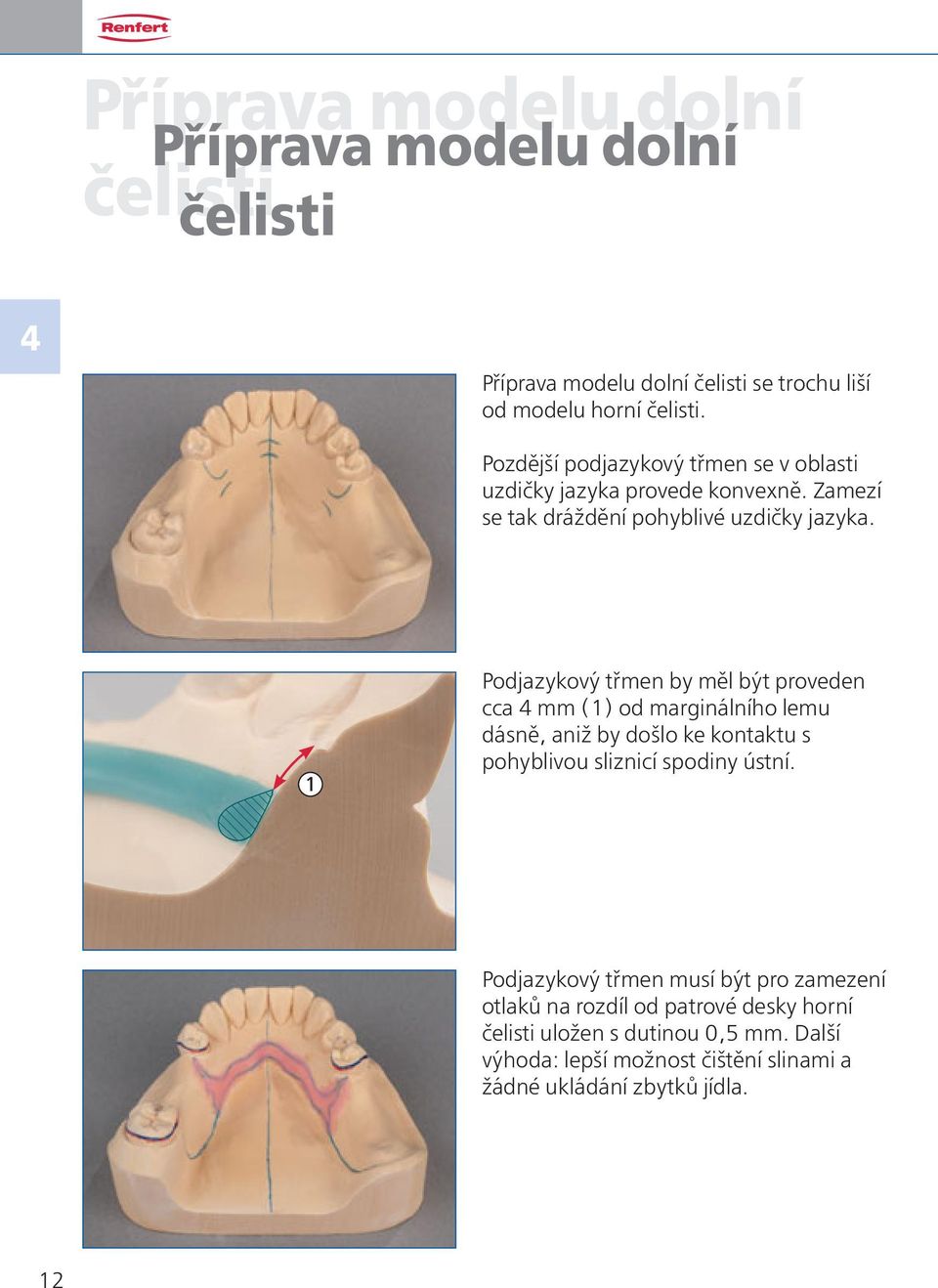 1 Podjazykový třmen by měl být proveden cca 4 mm (1) od marginálního lemu dásně, aniž by došlo ke kontaktu s pohyblivou sliznicí spodiny ústní.