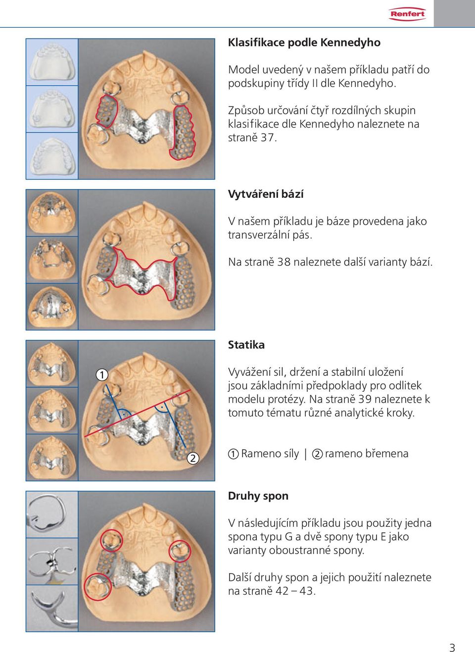 Na straně 38 naleznete další varianty bází. Statika 1 Vyvážení sil, držení a stabilní uložení jsou základními předpoklady pro odlitek modelu protézy.