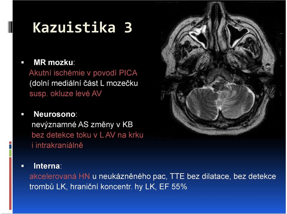 okluze levé AV Neurosono: nevýznamné AS změny v KB bez detekce toku v L AV