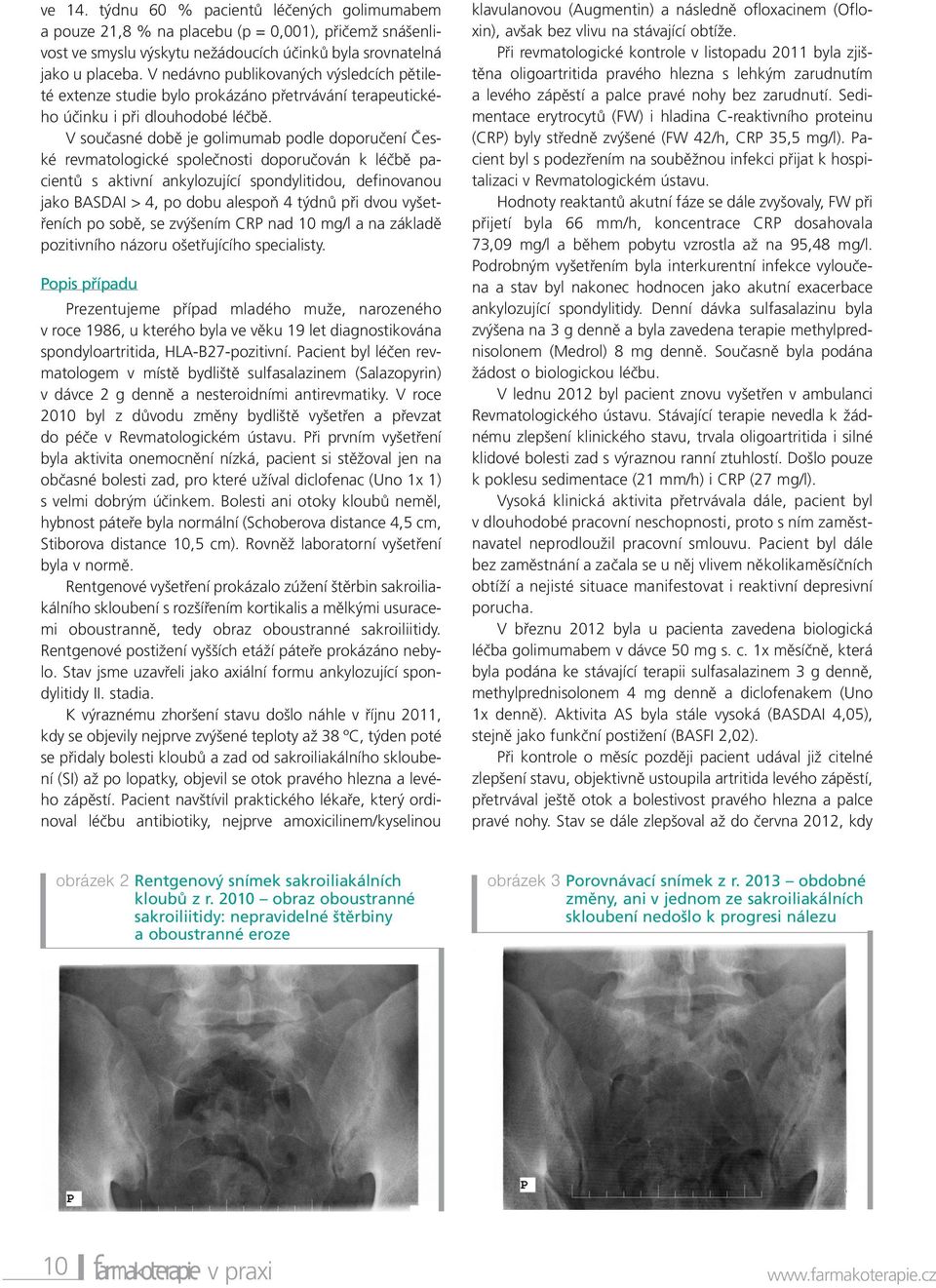 V současné době je golimumab podle doporučení České revmatologické společnosti doporučován k léčbě pacientů s aktivní ankylozující spondylitidou, definovanou jako BASDAI > 4, po dobu alespoň 4 týdnů