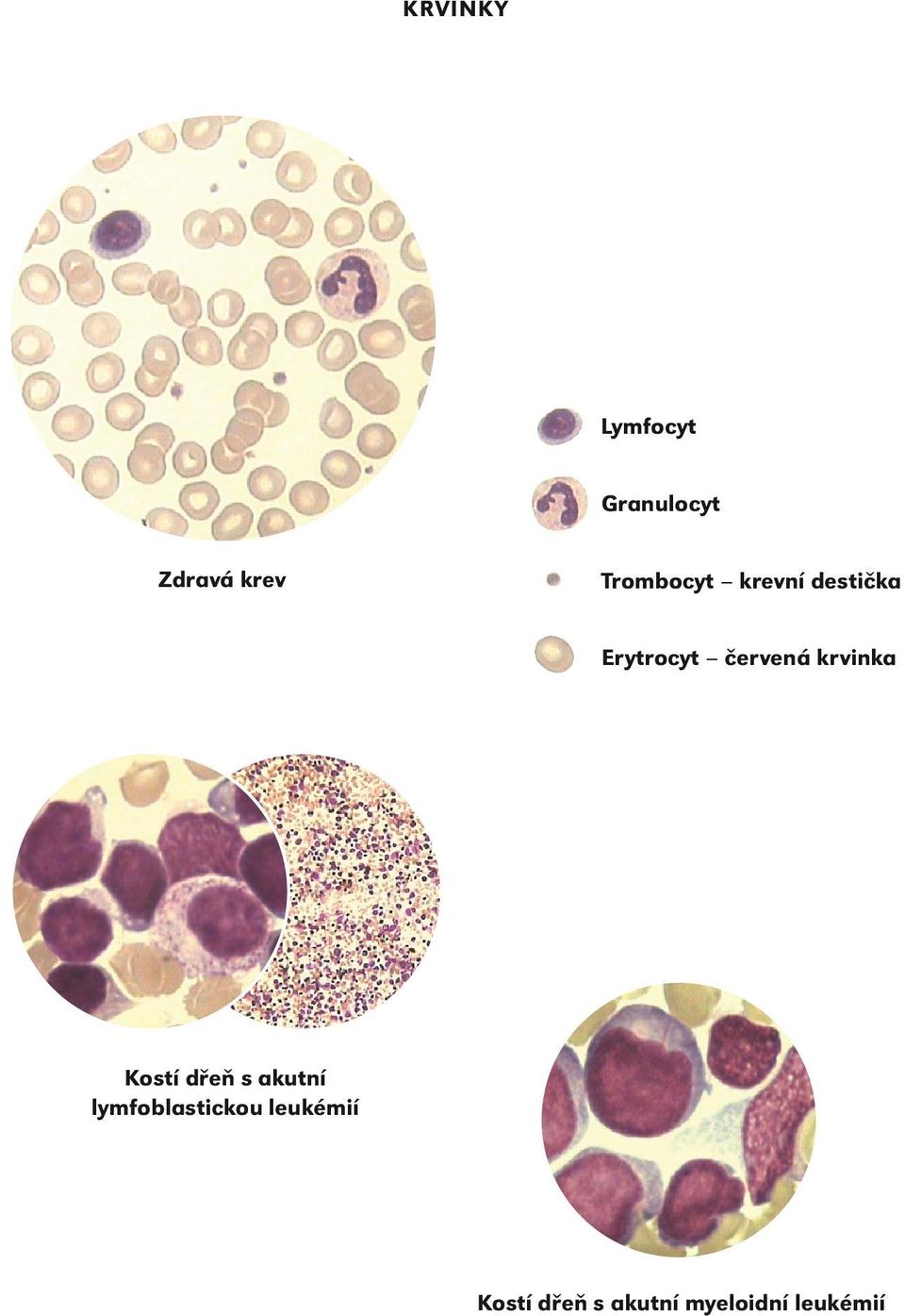 krvinka Kostí dřeň s akutní lymfoblastickou