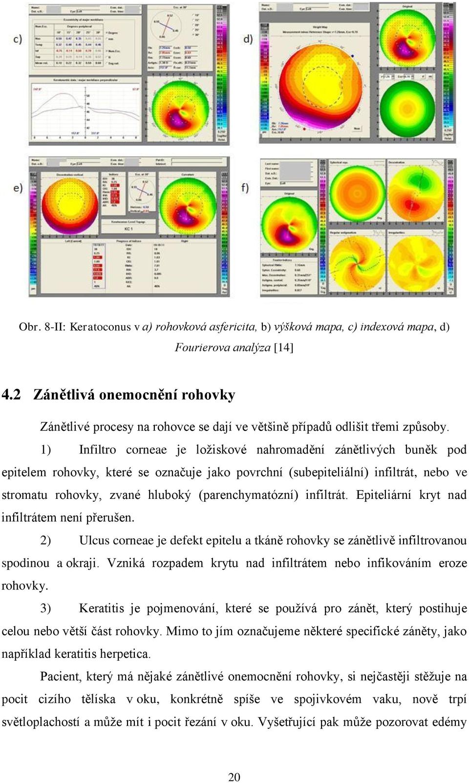 1) Infiltro corneae je ložiskové nahromadění zánětlivých buněk pod epitelem rohovky, které se označuje jako povrchní (subepiteliální) infiltrát, nebo ve stromatu rohovky, zvané hluboký