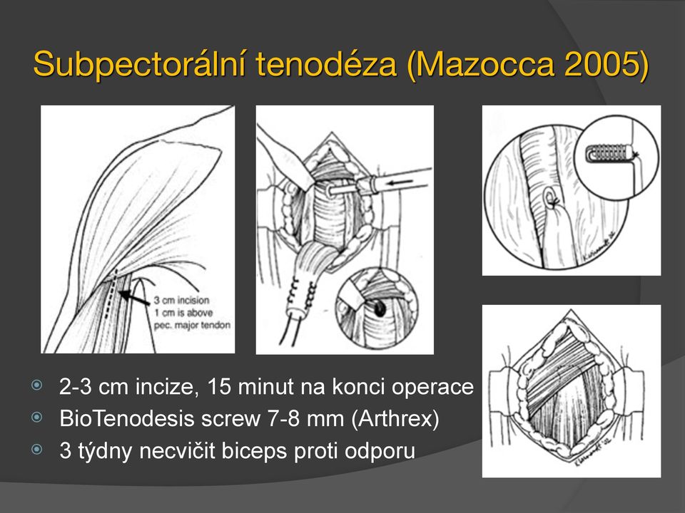 operace BioTenodesis screw 7-8 mm